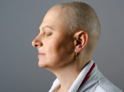 Taxotere Permanent Alopecia