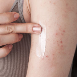Applying an emollient to dry flaky skin as in the treatment of psoriasis, eczema and other dry skin conditions