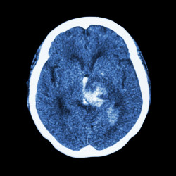 Pradaxa intracranial hemorrhage