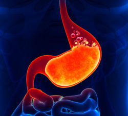 acid reflux and heartburn