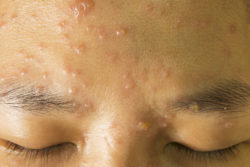 Stevens Johnson syndrome SJS