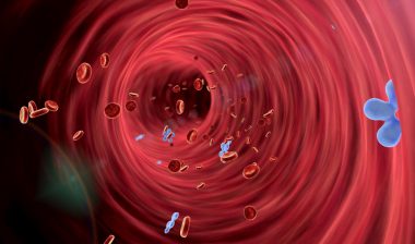 IVC filter complications