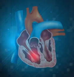 heart, clot