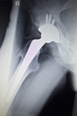 Pinnacle Hip Implant Lawsuit