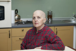 taxotere-hair-loss