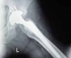 Stryker hip implant recall