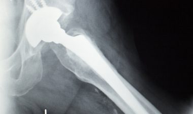 Stryker hip implant recall