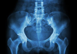 Metal Hip Implant