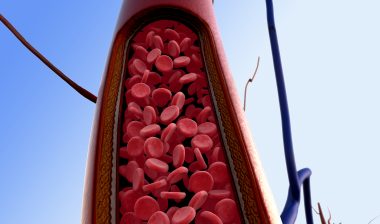 blood-clot-filter-risks