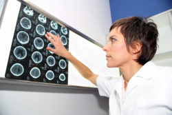 Dilantin Brain Side Effects