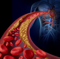 IVC Filter