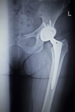 X-ray scan image of hip joint replacement orthopedic implant