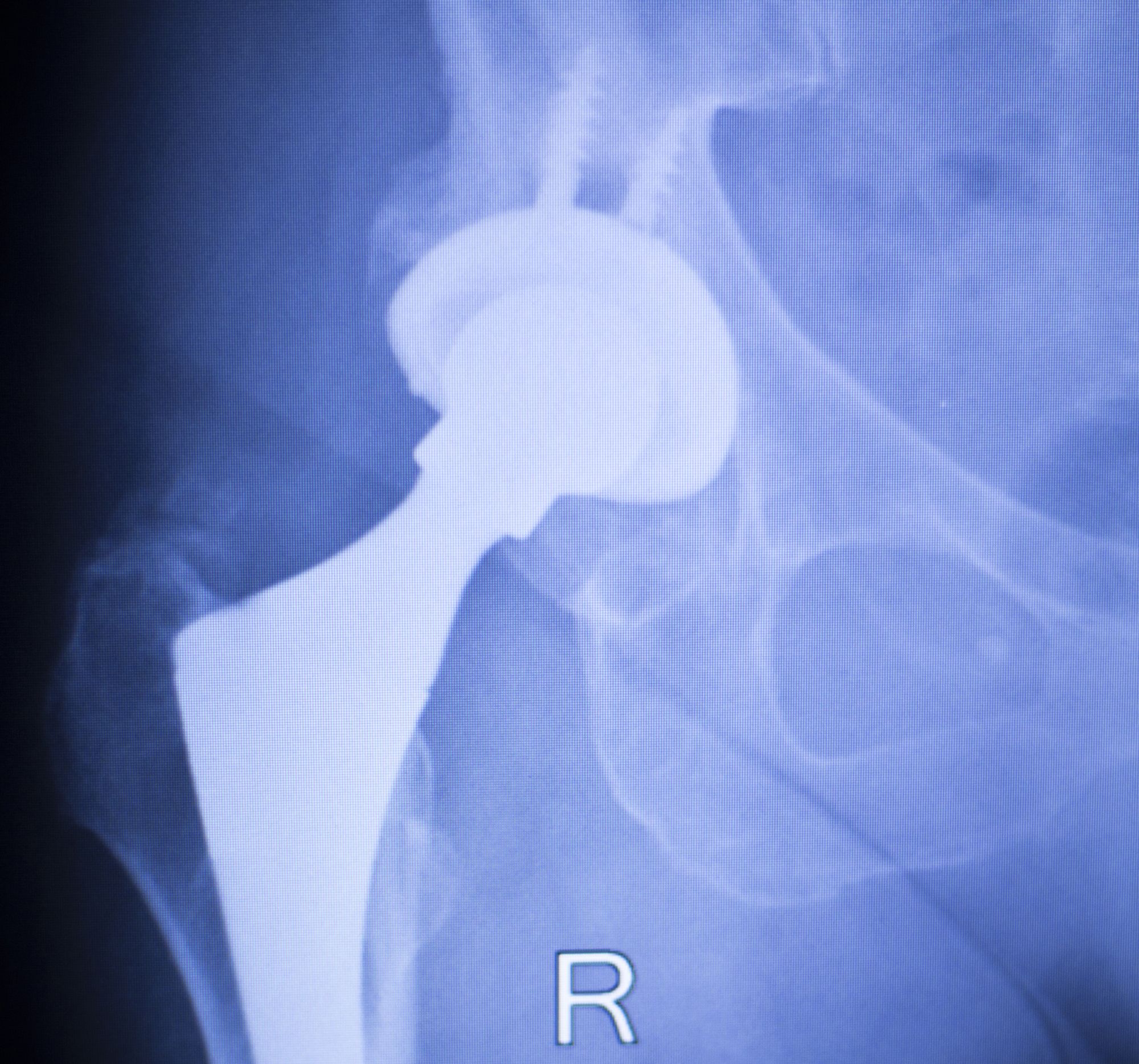 Stryker-Accolade-hip-implant-recall