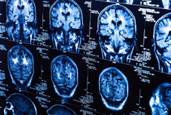 Dilantin-induced-cerebral-atrophy