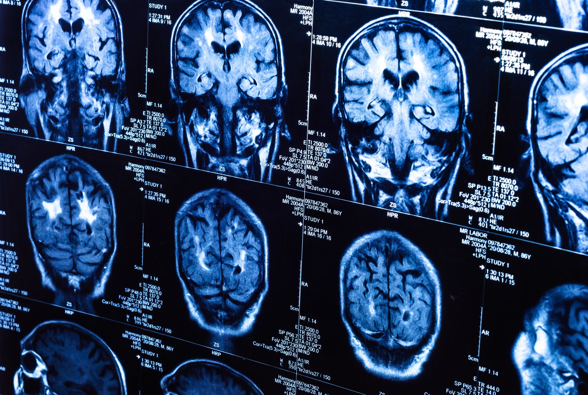Dilantin-induced-cerebral-atrophy