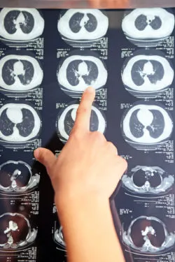 xray pulmonary embolism