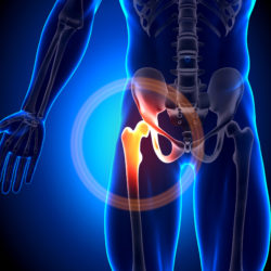 DePuy ASR hip implant settlement