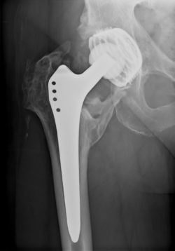 DePuy Metal Hip