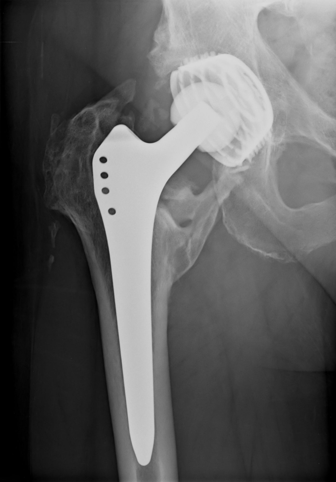 DePuy Metal Hip Implant Lawsuit filed by Wisconsin Man Top Class Actions