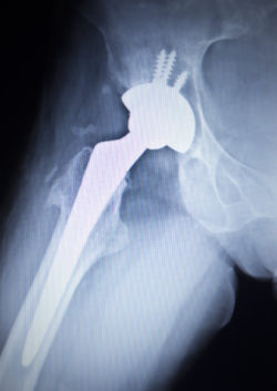 Stryker metal hip implant recall