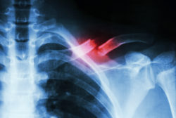 shoulder fracture
