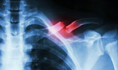 shoulder fracture