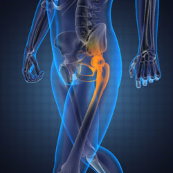 DePuy ASR Pinnacle Zimmer complications