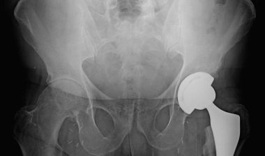 DePuy hip settlement ASR recall