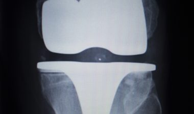 Zimmer Persona knee implant recall