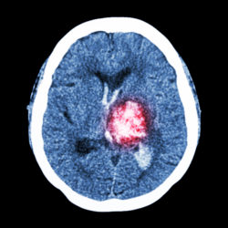 Xarelto bleeding hemorrhage