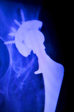 DePuy ASR hip implant recall