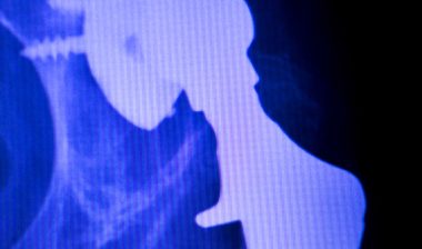 DePuy ASR hip implant recall