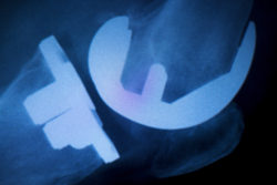 Zimmer Persona tibial plate recall