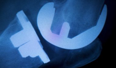 Zimmer Persona tibial plate recall