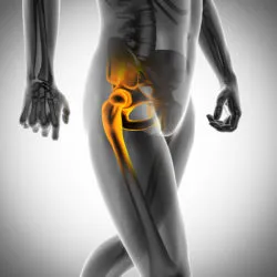 Stryker metal hip implant hip replacement