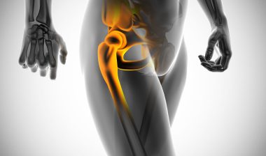 Stryker metal hip implant hip replacement