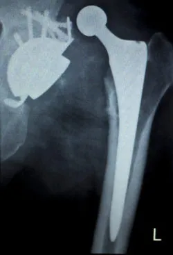 metal hip replacement xray