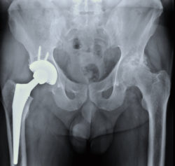 hip-revision-surgery