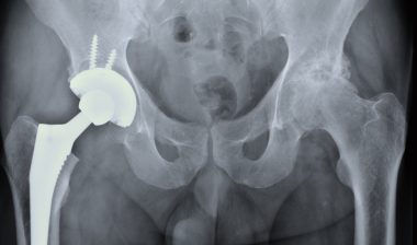 hip-revision-surgery