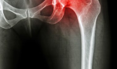 hip implant complications DePuy Zimmer Stryker xray