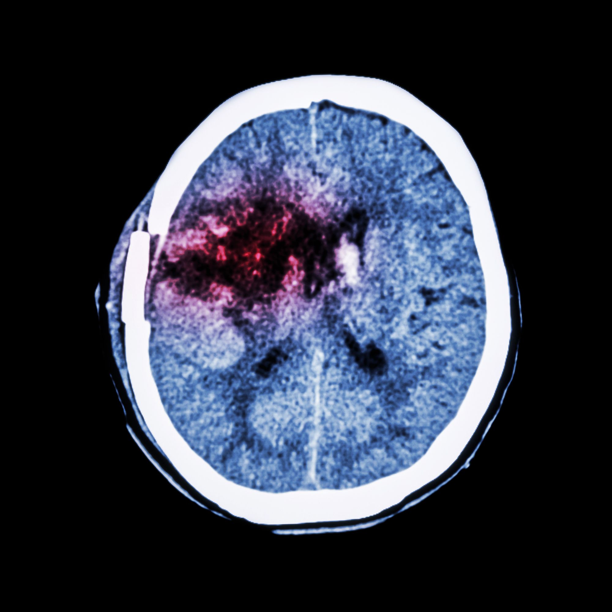 Eliquis Intracranial Hemorrhage Possible Medication Side Effect