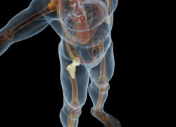 DePuy Zimmer hip implant metal metallosis