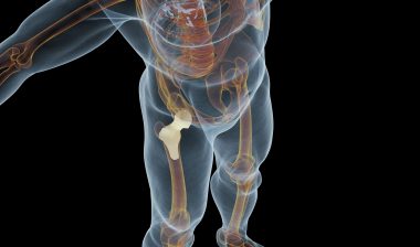 DePuy Zimmer hip implant metal metallosis
