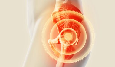 hip replacement, hip implant xray