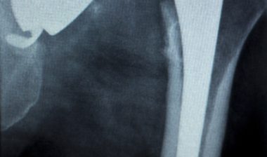 Stryker-LFIT-V40-Femoral-Head