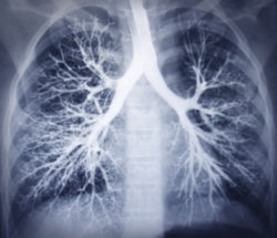 lung xray