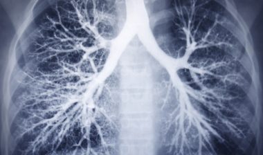 lung xray