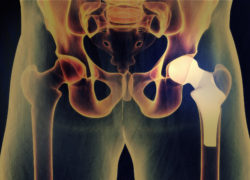 DePuy Zimmer hip replacement hip implant