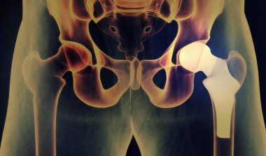 DePuy Zimmer hip replacement hip implant