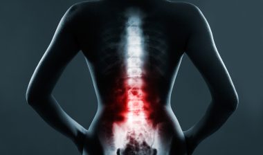 spinal fusion stimulator recall